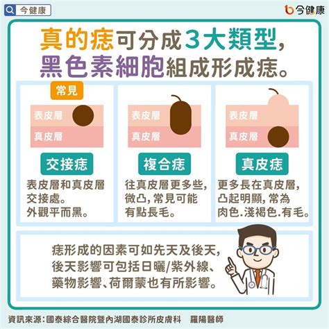 凸起來的痣|是痣or皮膚癌？醫「1張圖秒對照」 長這2部位最危險